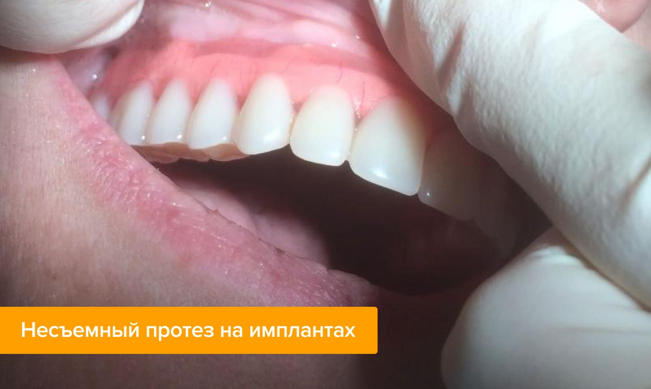 Чем отличается зубные протезы. Смотреть фото Чем отличается зубные протезы. Смотреть картинку Чем отличается зубные протезы. Картинка про Чем отличается зубные протезы. Фото Чем отличается зубные протезы