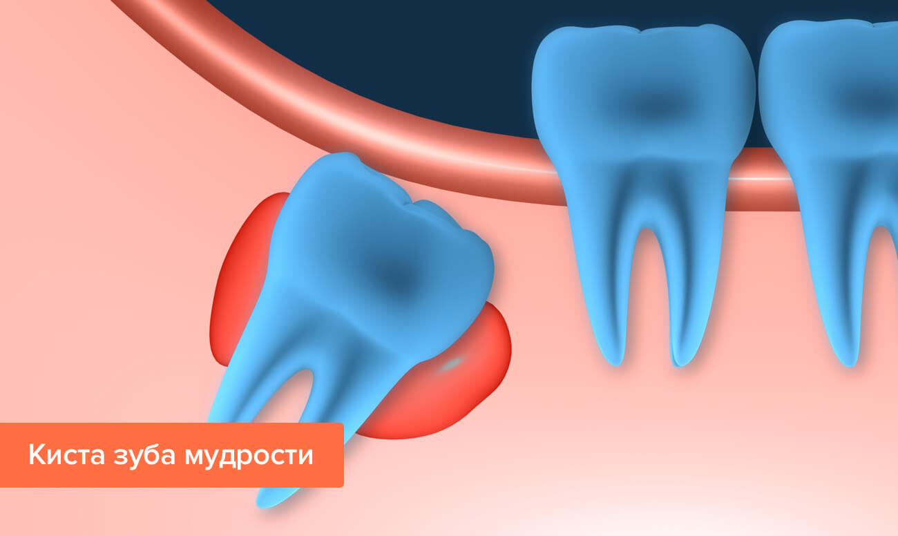 Киста зуба мудрости в картинках