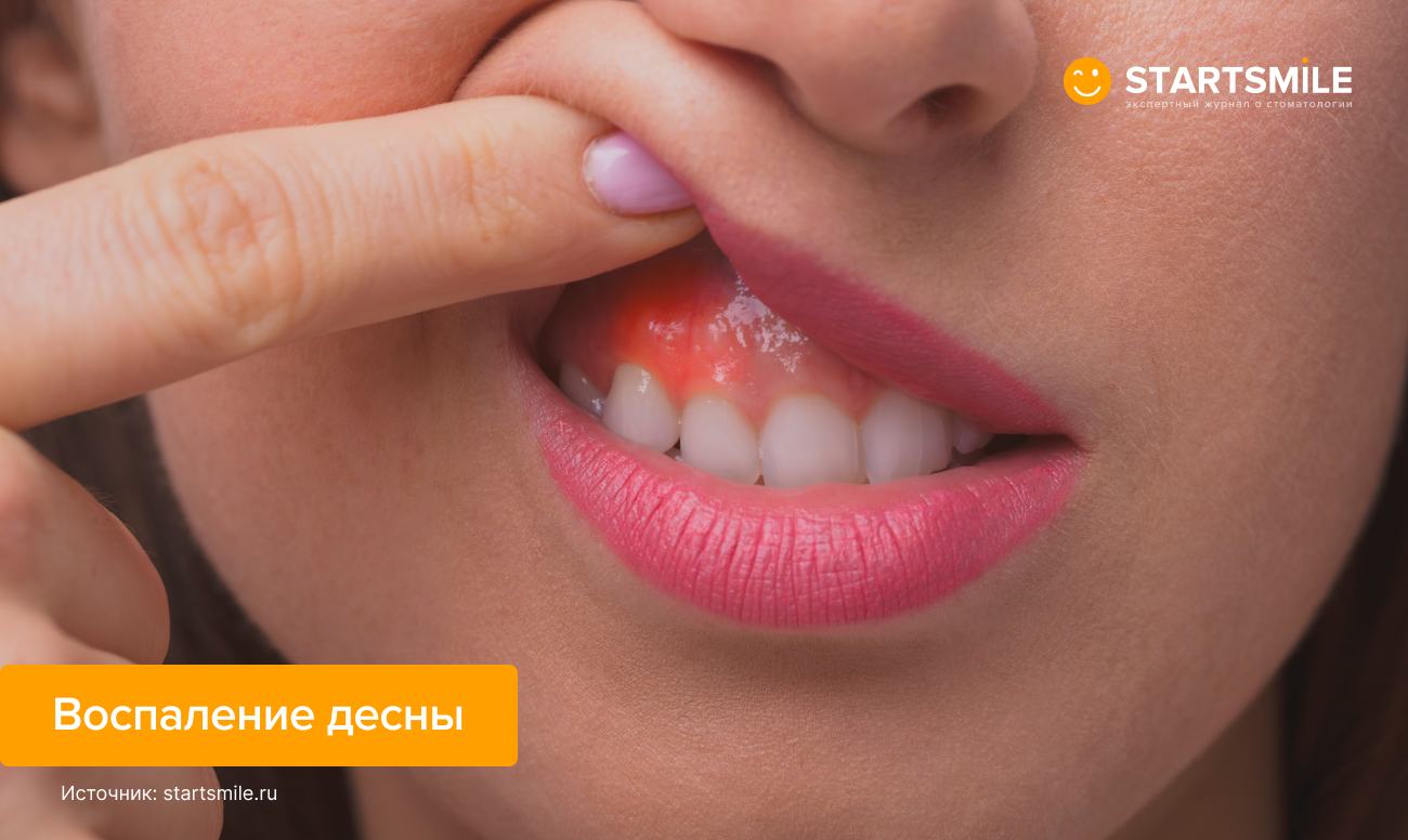 Воспаление десны Фото воспаленной десны у девушки.