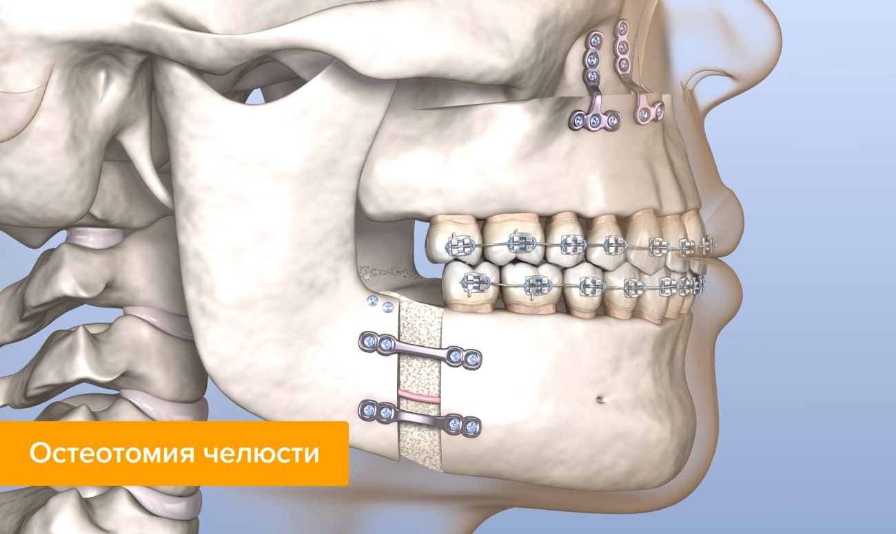 Остеотомия челюсти в картинках