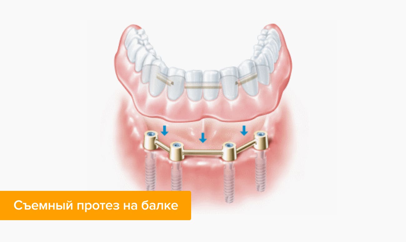 Протез на имплантах при полном отсутствии. Балочный протез на 4 имплантах. Условно-съемные балочные протезы. Покрывной протез на имплантах. Несъемные зубные протезы на 4 имплантах.