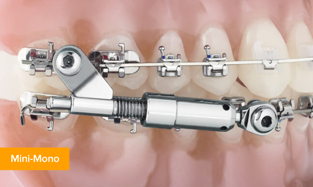 Брекеты Mini-Mono Forestadent Фото брекетов Mini-Mono Forestadent