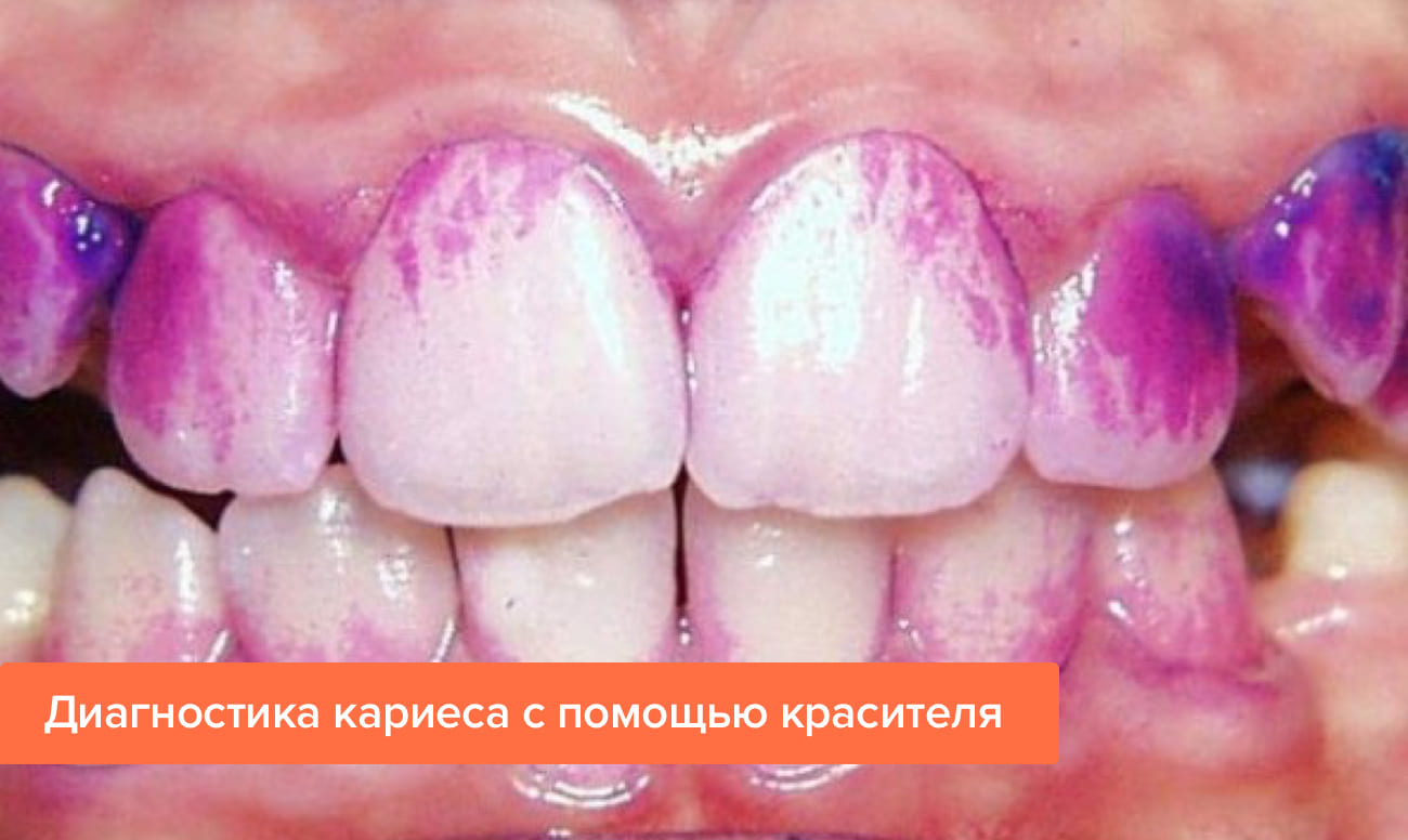 Фото диагностики кариеса с помощью красителя