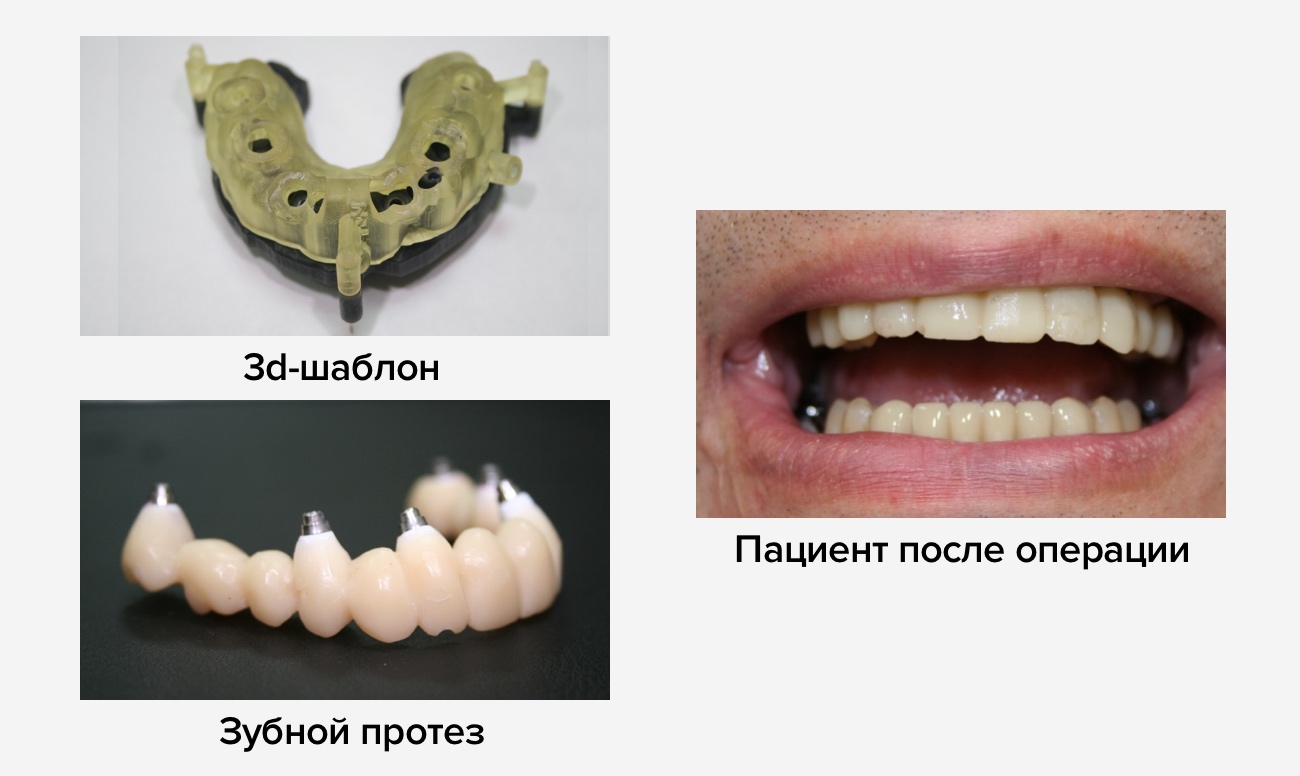 Фото до и после 3D имплантации