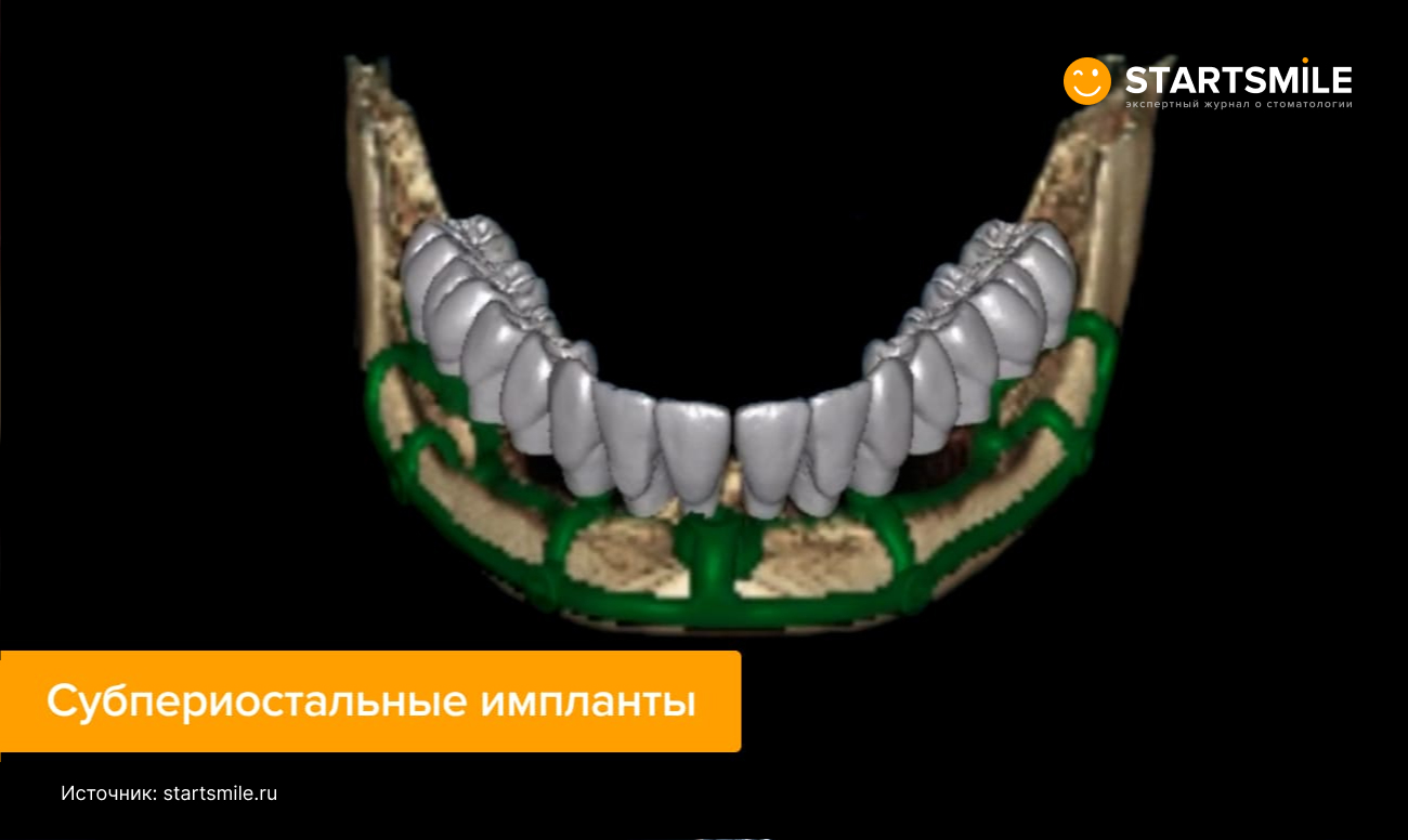 Фото субпериостальных имплантов.