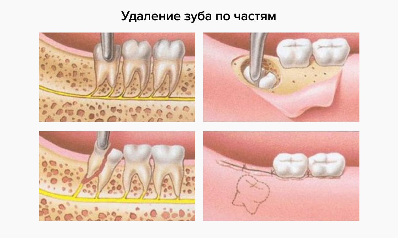 Удалить зуб последствие