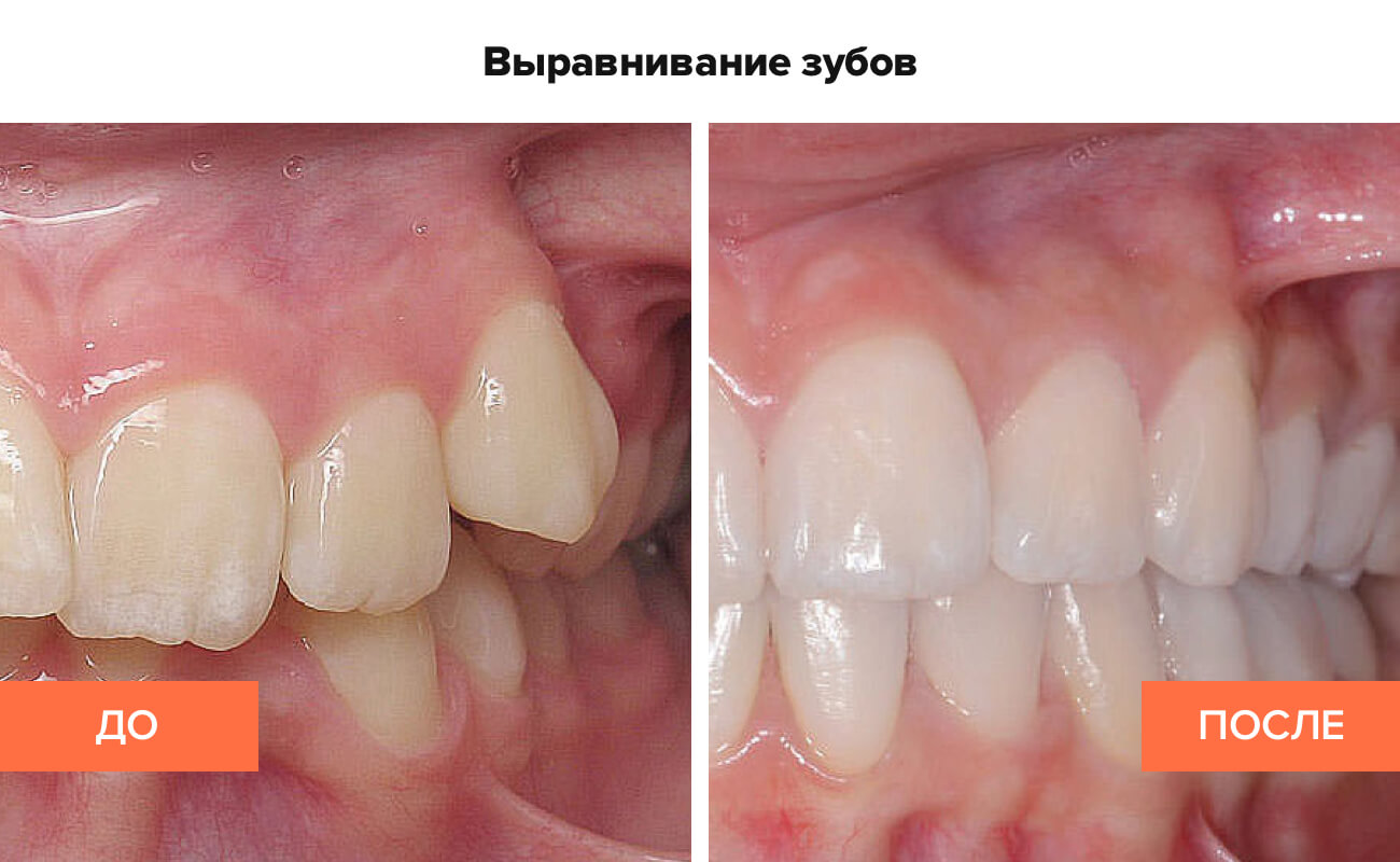 Фото пациента до и после выравнивания зубов