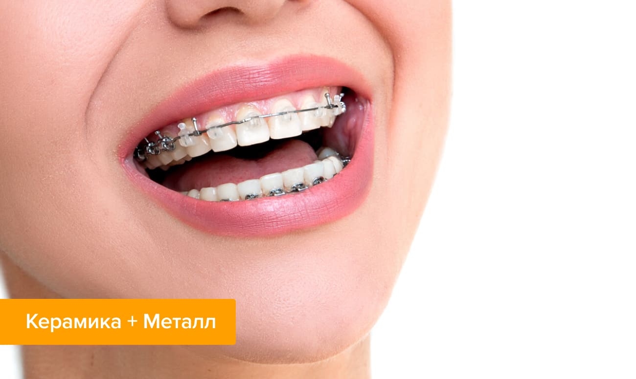 Фото комбинированных брекетов на зубах – керамика+металл