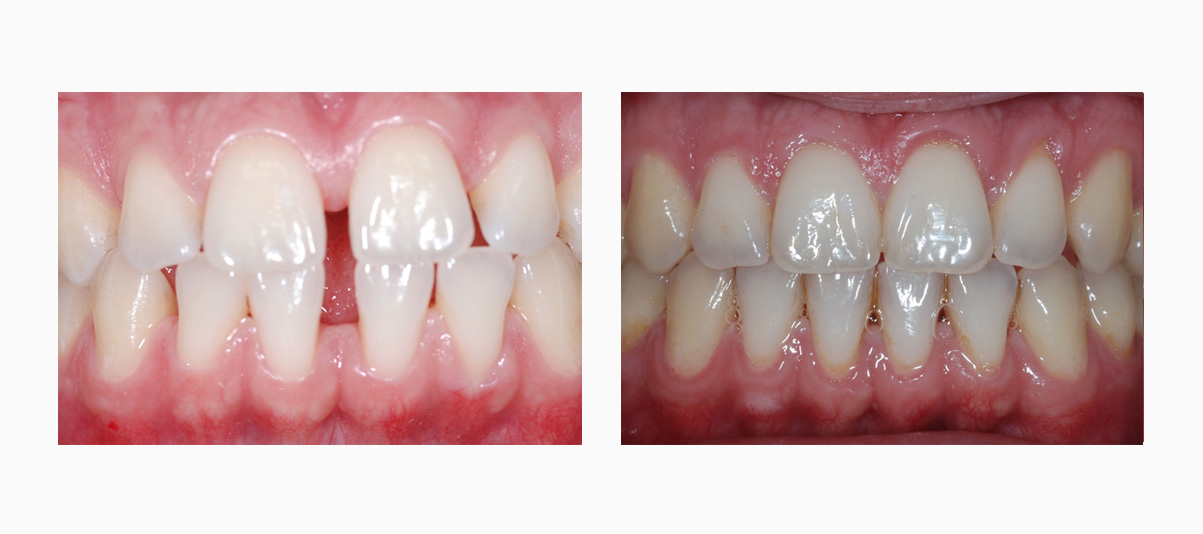 Фото до и после лечения элайнерами Invisalign Фото пациента до и после лечения элайнерами Invisalign