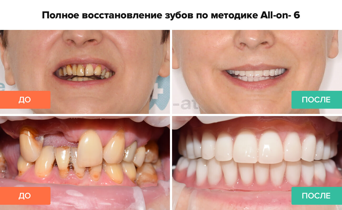 Фото до и после восстановления зубов по методике All-on-6 Фото пациента до и после восстановления зубов по методике All-on-6