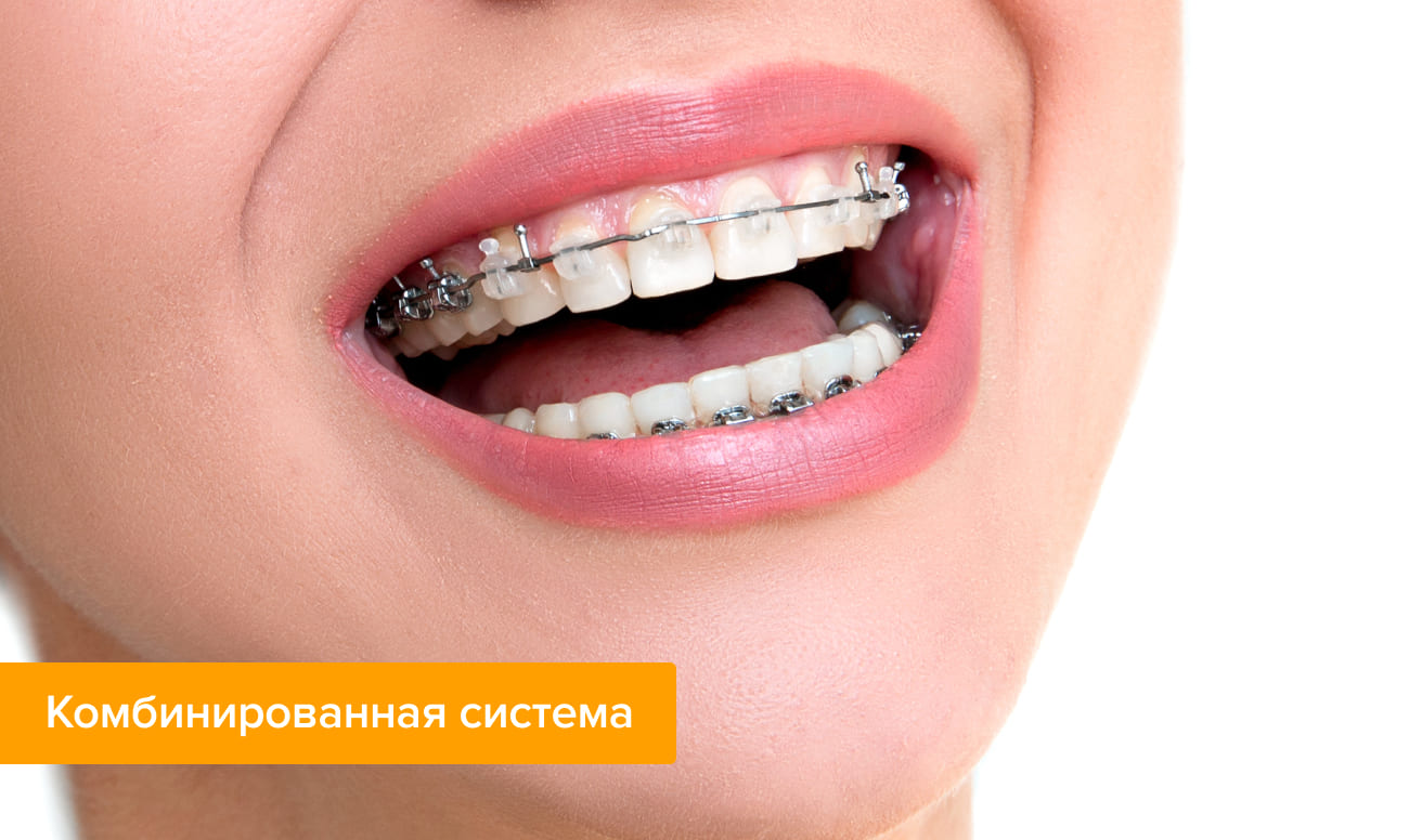 Фото комбинированной системы на зубах у девушки