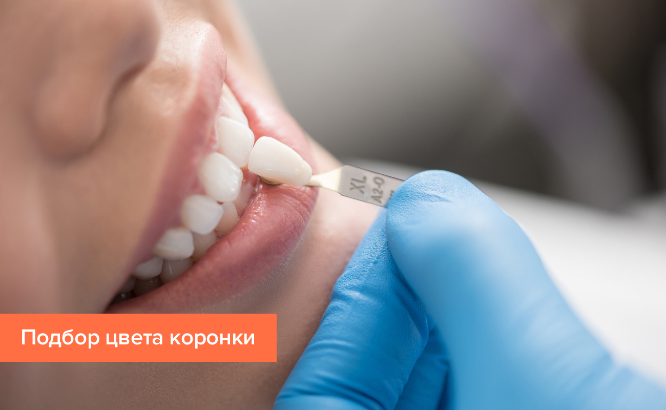 Коронки цвета зуба Коронки цвета зуба