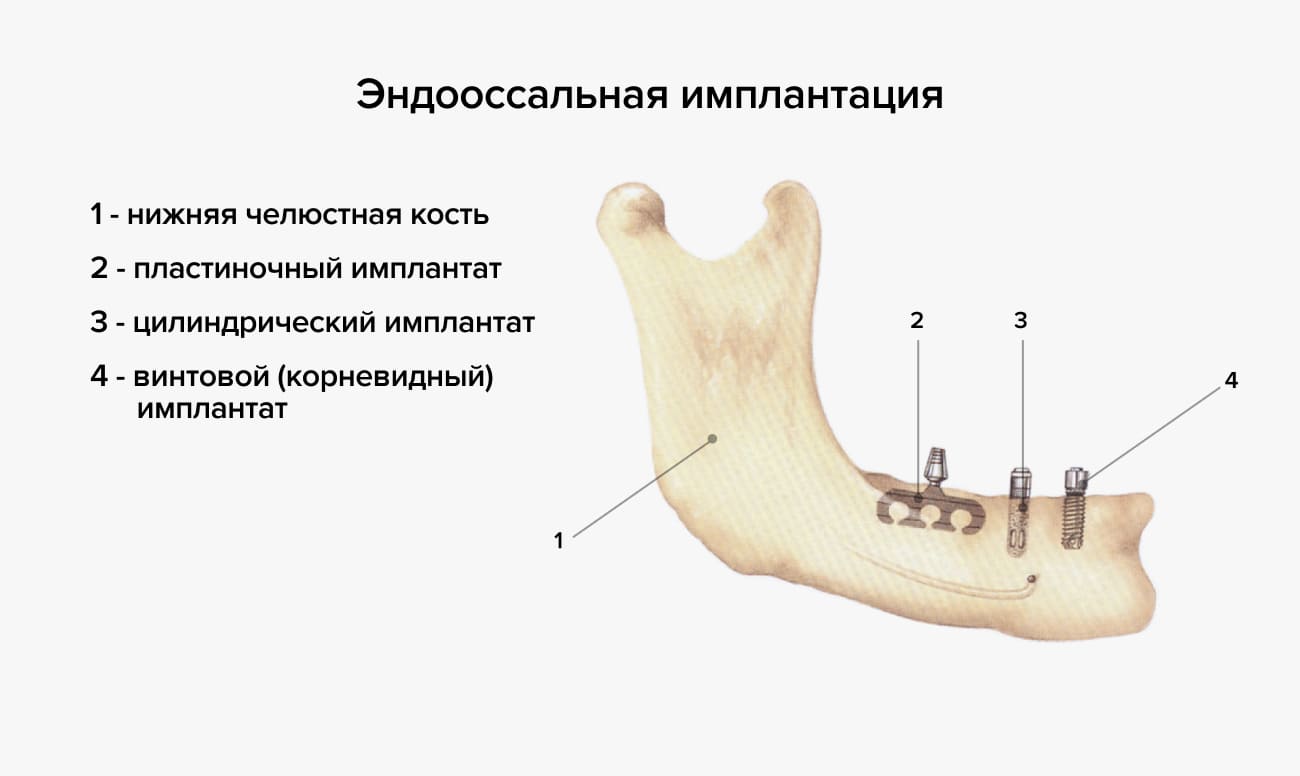 Эндооссальная имплантация в картинках