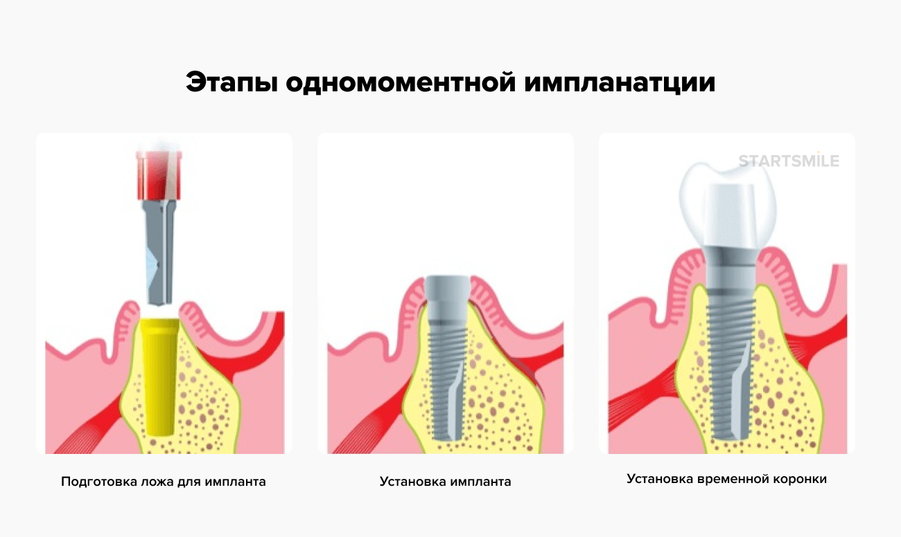 Одноэтапная имплантация в картинках