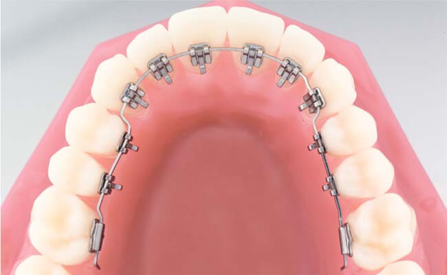 Фото лингвальной брекет-системы In-Ovation L на зубах