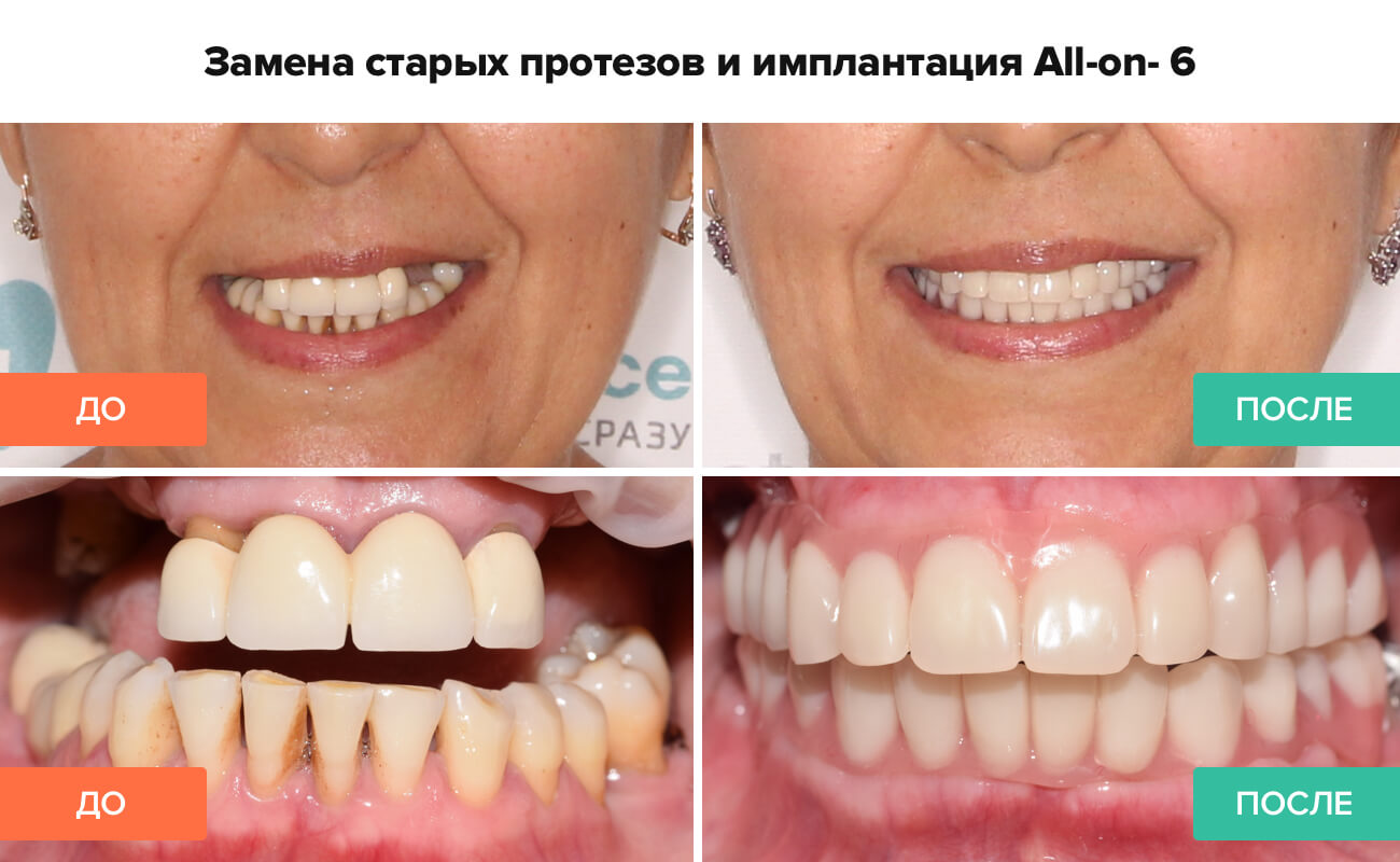 Фото до и после имплантации зубов методом All-on-6 Фото пациента до и после имплантации зубов методом All-on-6