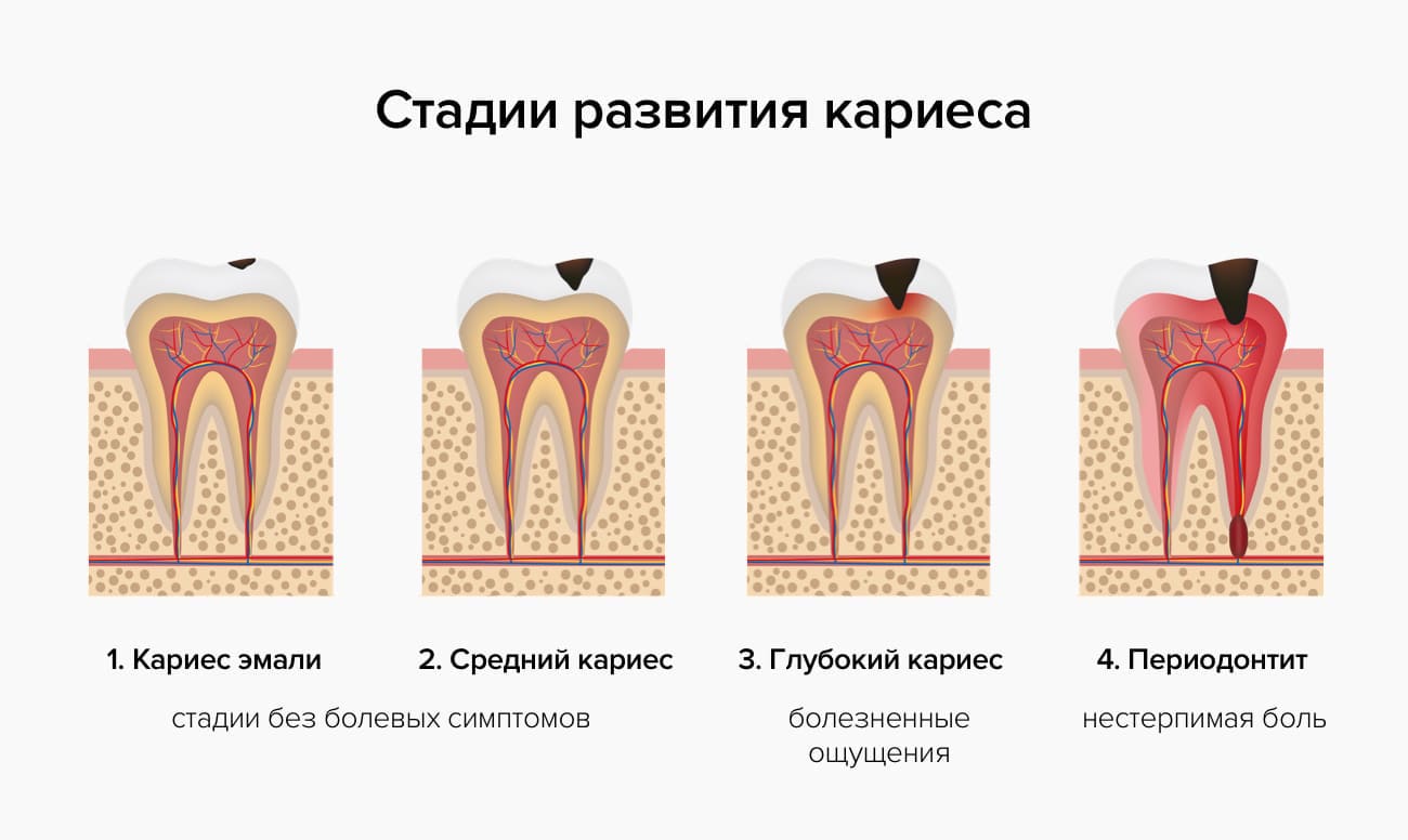 Стадии развития кариеса в картинках