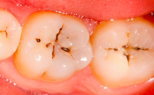 Фото пациента с фиссурным кариесом зубов.