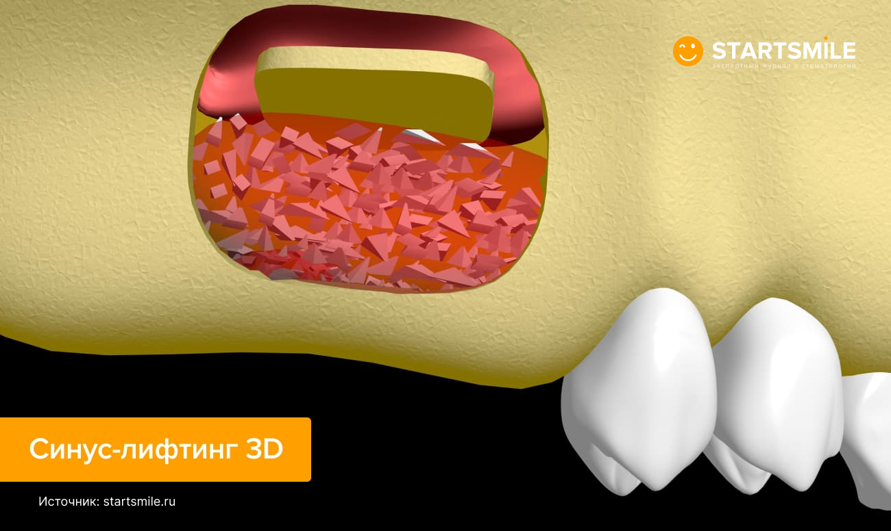 Синус-лифтинг 3D