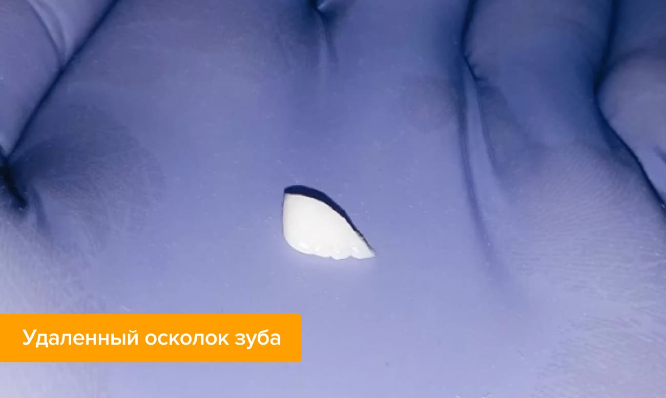 Удаленный осколок зуба Фото удаленного осколка зуба