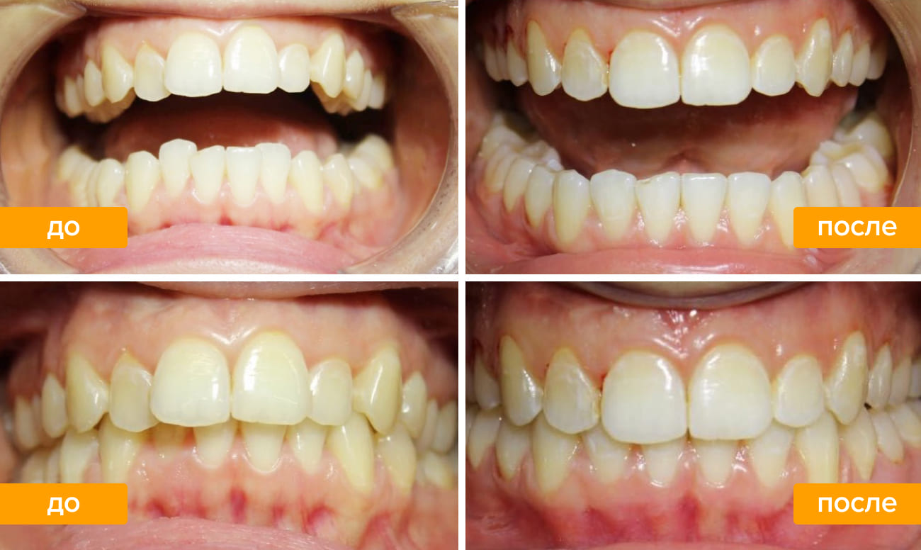 После брекетов нужно носить капы. Исправление зубов капами. Капы до и после для исправления прикуса.