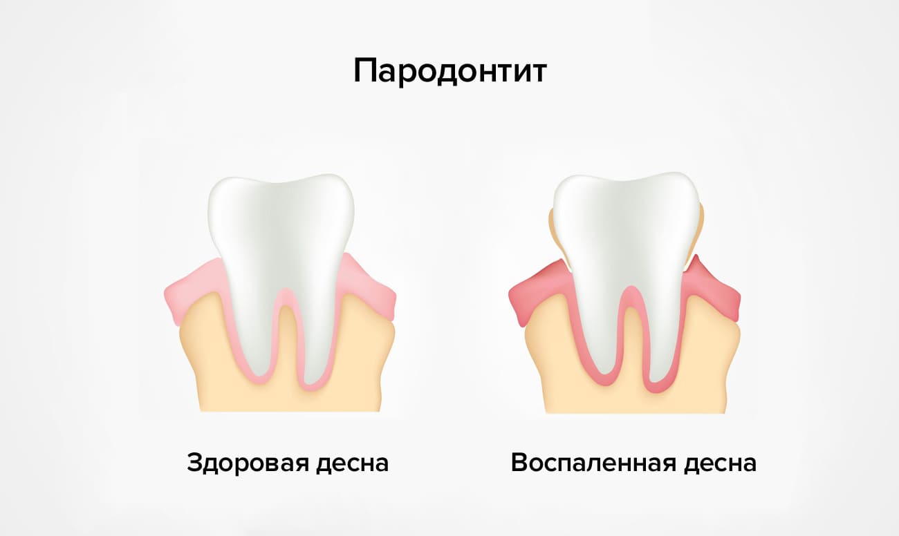 Пародонтит в картинках
