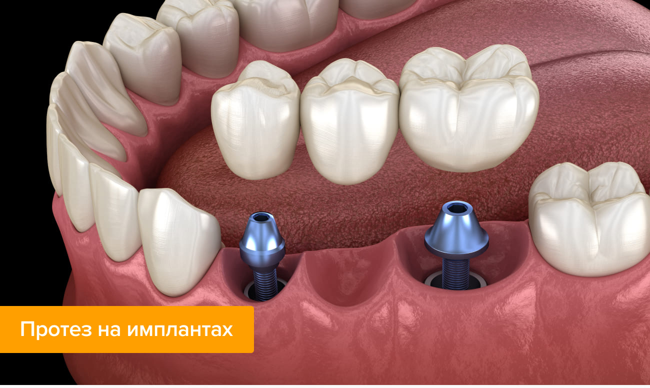 Протез на имплантах в картинках