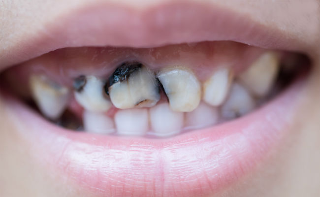 Фото кариеса молочных зубов