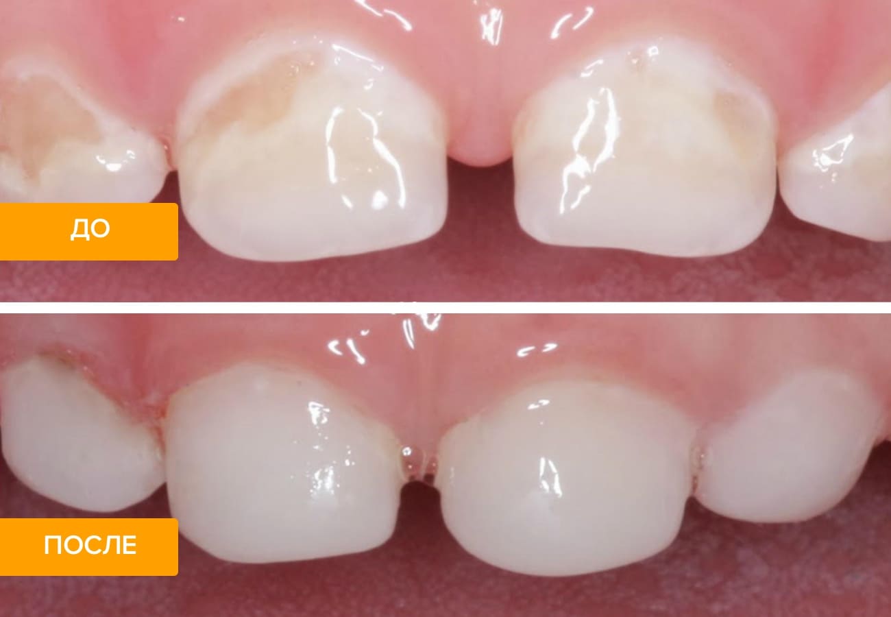 Фото зубов до и после лечения гипоплазии эмали у ребенка