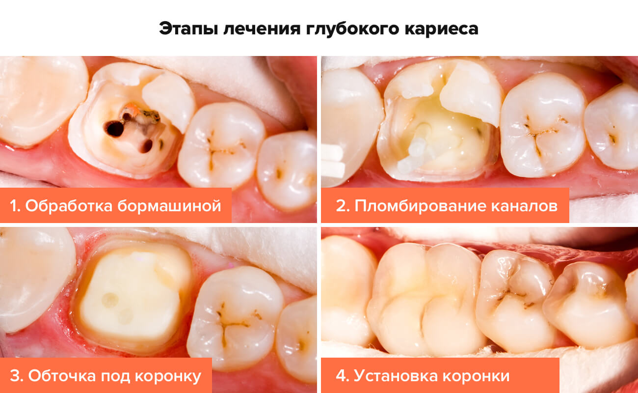 Фото этапов лечения глубокого кариеса