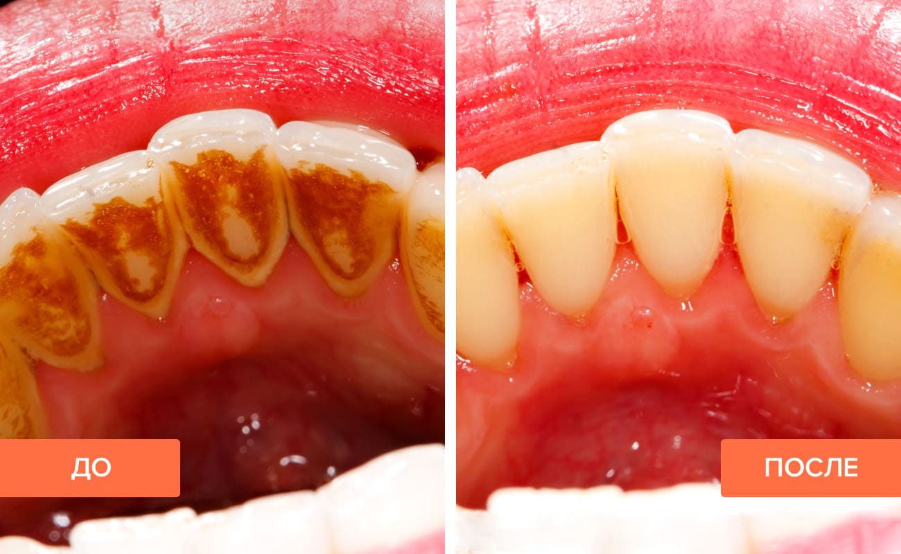 Как удалить зубной камень, и почему он появляется?