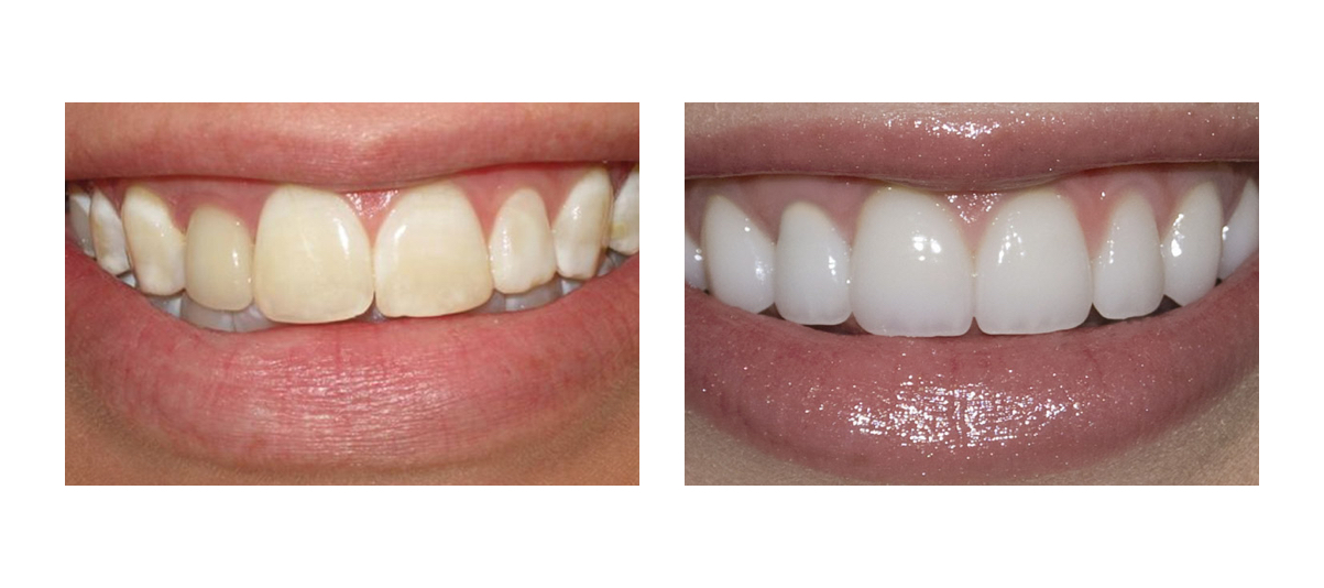 Фото пациента до и после ламинирования зубов