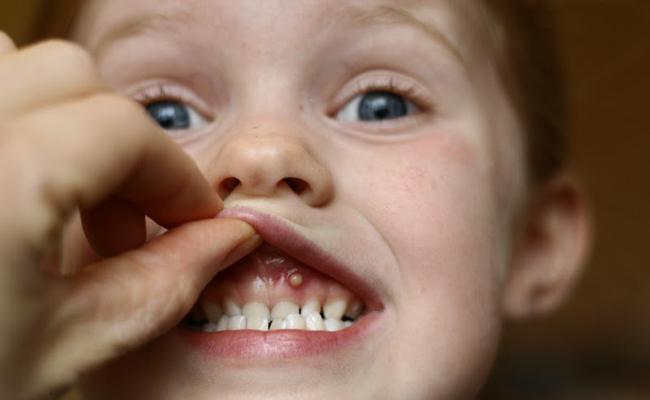 Фото кисты десны зуба у ребенка
