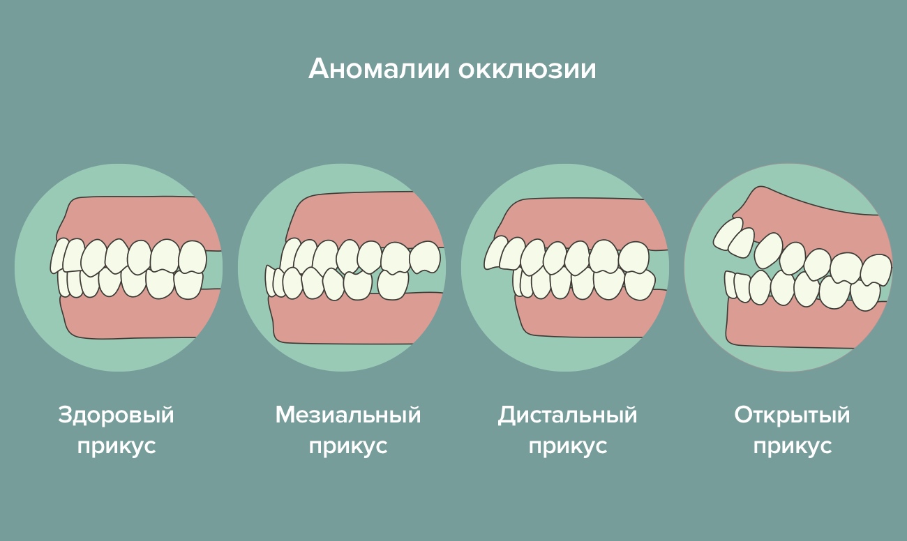 Аномалии окклюзии в картинках