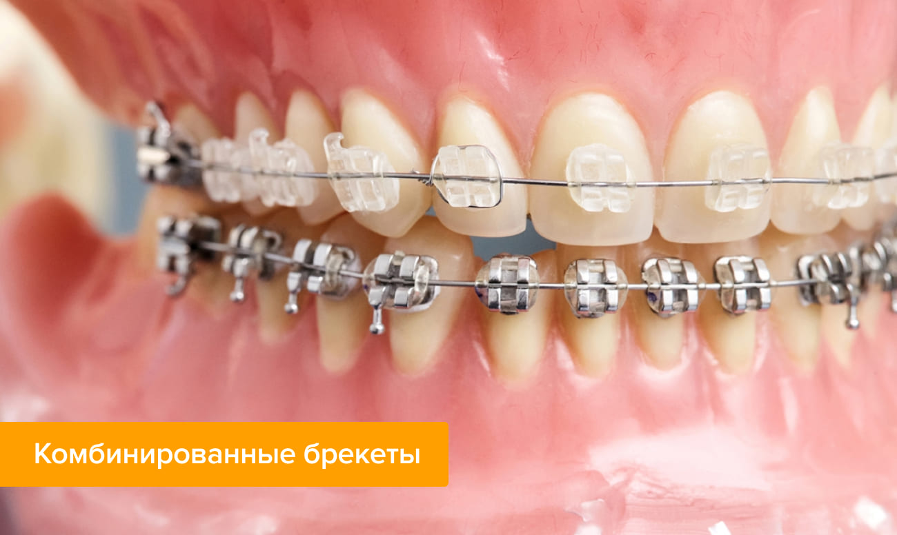 Фото комбинированных брекетов