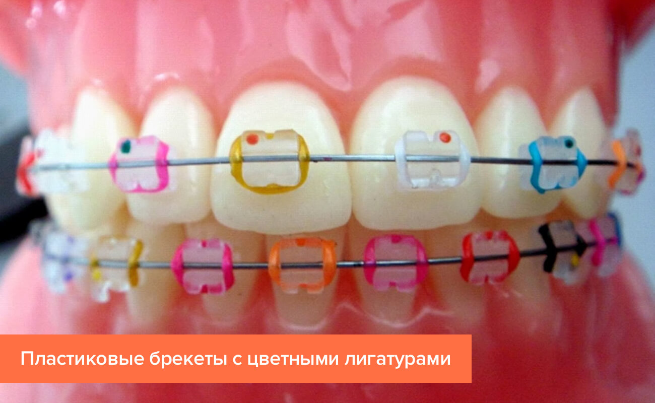 Фото пластиковых брекетов с цветными лигатурами на зубах