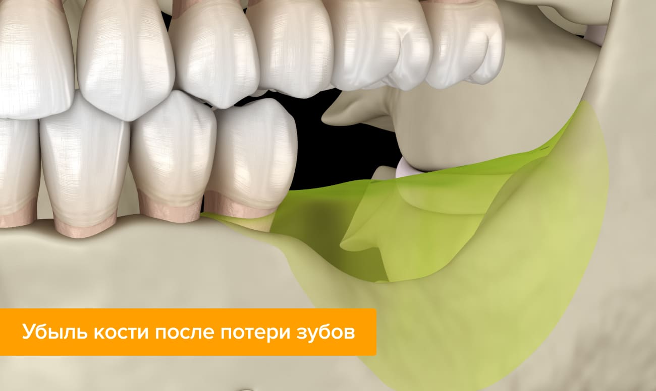 можно ли восстановить зубную кость. Смотреть фото можно ли восстановить зубную кость. Смотреть картинку можно ли восстановить зубную кость. Картинка про можно ли восстановить зубную кость. Фото можно ли восстановить зубную кость