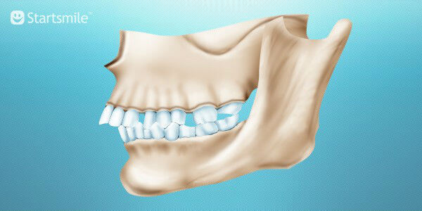 Неправильный прикус зубов – как выглядит и его последствия