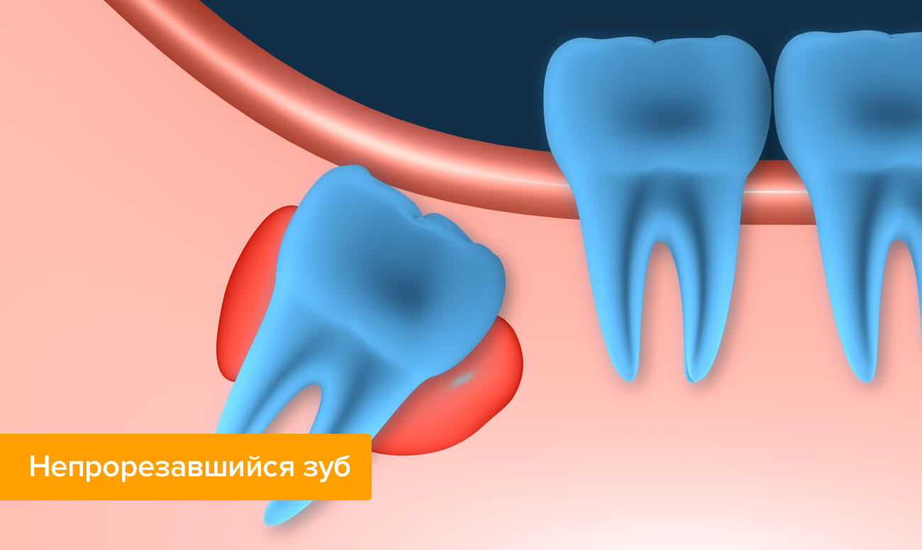 Непрорезавшийся зуб в картинках