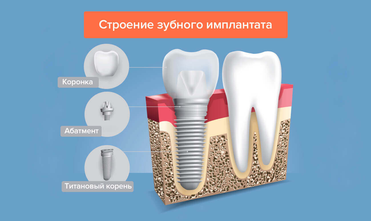 Что такое абатмент в стоматологии при имплантации. Смотреть фото Что такое абатмент в стоматологии при имплантации. Смотреть картинку Что такое абатмент в стоматологии при имплантации. Картинка про Что такое абатмент в стоматологии при имплантации. Фото Что такое абатмент в стоматологии при имплантации