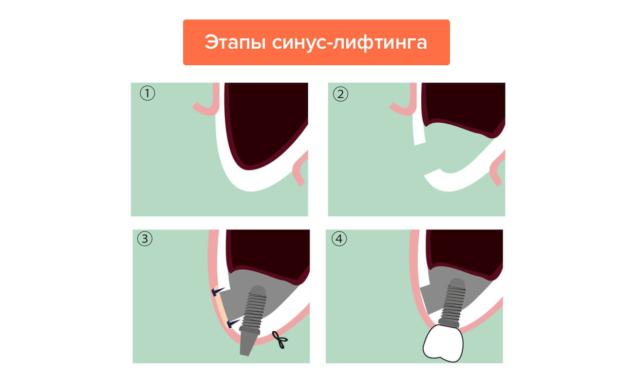 Этапы синус-лифтинга в картинках