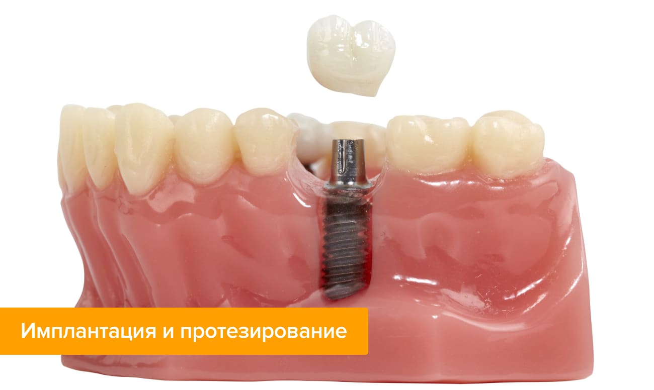имплант зуба какой лучше всего ставить. Смотреть фото имплант зуба какой лучше всего ставить. Смотреть картинку имплант зуба какой лучше всего ставить. Картинка про имплант зуба какой лучше всего ставить. Фото имплант зуба какой лучше всего ставить