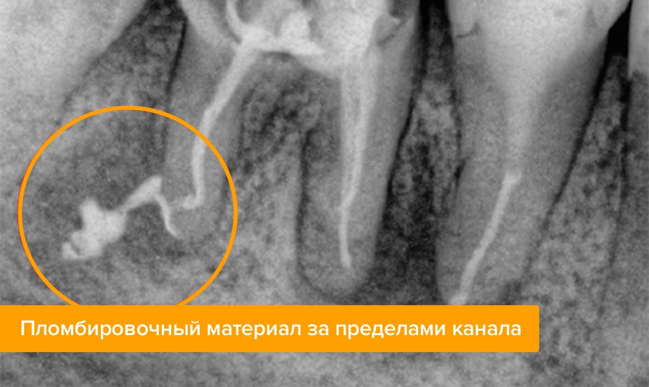 Пломбировочный материал за пределами канала на рентгене