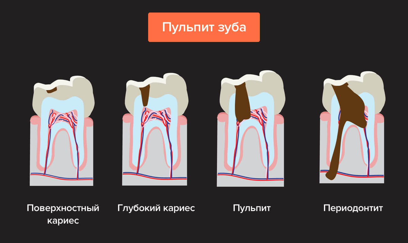 Стадии развития кариеса в картинках