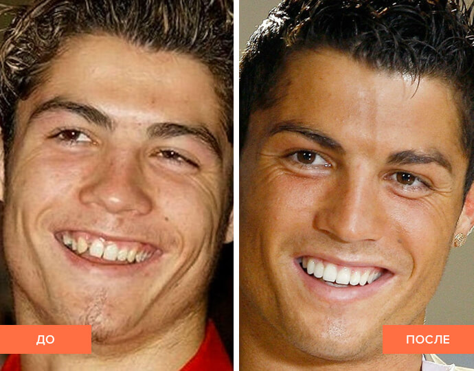 Фото зубов Криштиану Роналду до и после брекетов