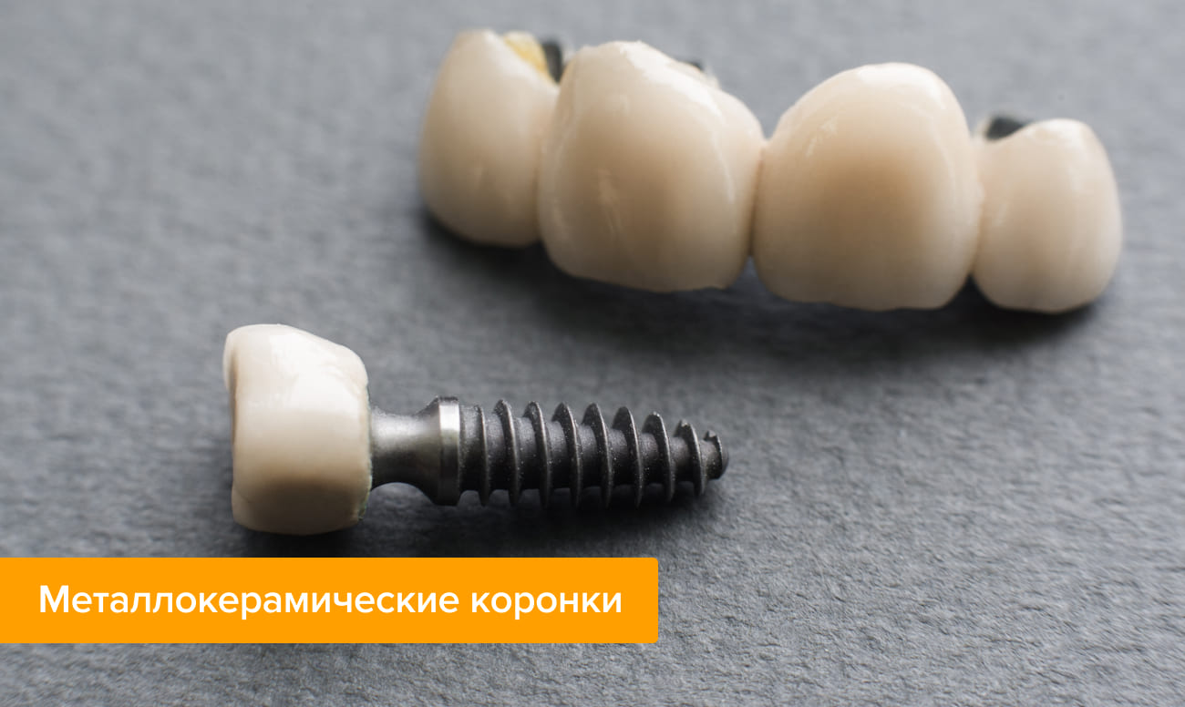 какие лучше делать коронки на импланты. Смотреть фото какие лучше делать коронки на импланты. Смотреть картинку какие лучше делать коронки на импланты. Картинка про какие лучше делать коронки на импланты. Фото какие лучше делать коронки на импланты