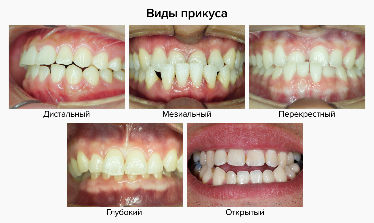 Фото существующих видов прикуса