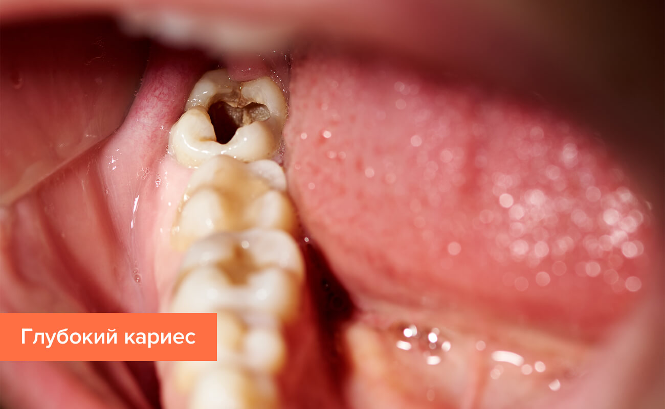 foto bolezni zubov