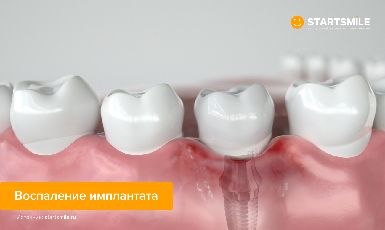 Воспаление имплантата Воспаление имплантата в картинках.
