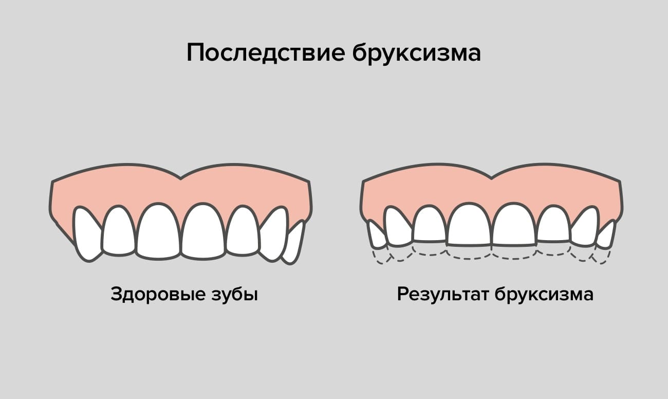 5 причин бруксизма и современные методы лечения скрежета зубами!